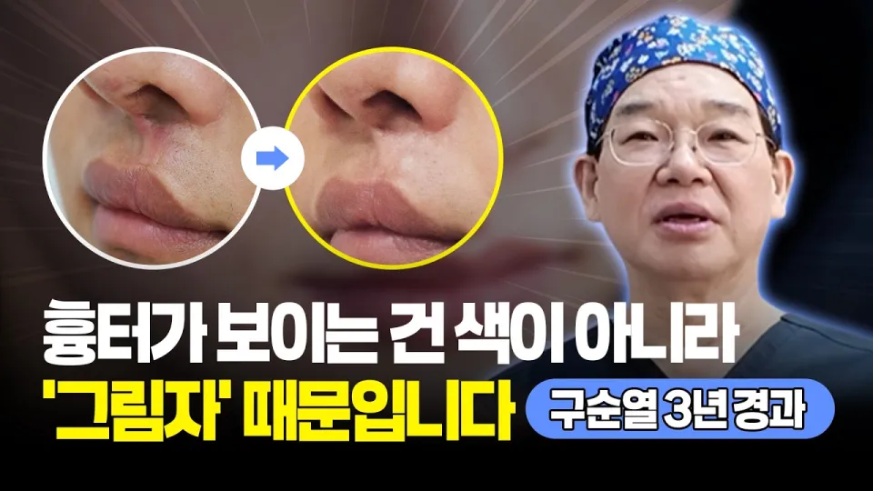 구순구개열 흉터 잘라내지 않고도 개선 가능합니다. | 인중 흉터 · 지방줄기세포 + 지방이식 | 보니따의원 흉터재건